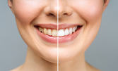 Кабинетно избелване на зъби, почистване на зъбен камък с ултразвук и полиране, плюс обстоен дентален преглед