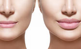 Уголемяване на устни или премахване на бръчки с безиглено влагане на 100% хиалуронова киселина