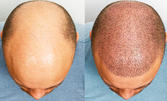 Сгъстяване на косата за мъже - Микропигментация на скалп SMP на зона до 10см