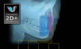 Дигитална панорамна рентгенова снимка на зъби или 2D+ изследване на отделен сегмент