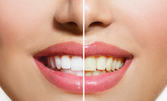 Изработване на индивидуални шини за професионално домашно избелване на зъби - с английската система White Dental Beauty, плюс обстоен преглед и консултация