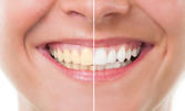 Клинично избелване на зъби, преглед и план за цялостно лечение