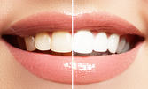 Избелване на зъби с LED лампа, почистване на зъбен камък с ултразвук и полиране, плюс обстоен преглед