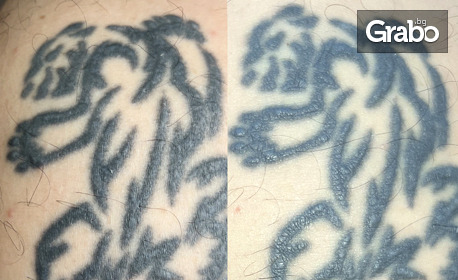 Безлазерно премахване на татуировки или перманентен грим с техниката NanoRemoval