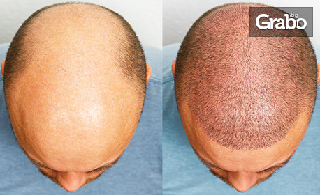 Сгъстяване на косата за мъже - Микропигментация на скалп SMP на зона до 10см
