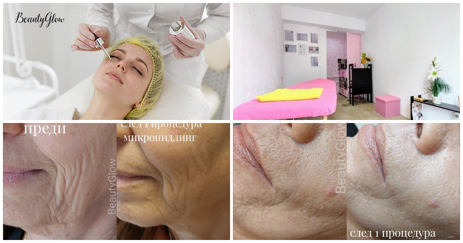 Химичен пилинг с гликолова киселина, от Студио BeautyGlow